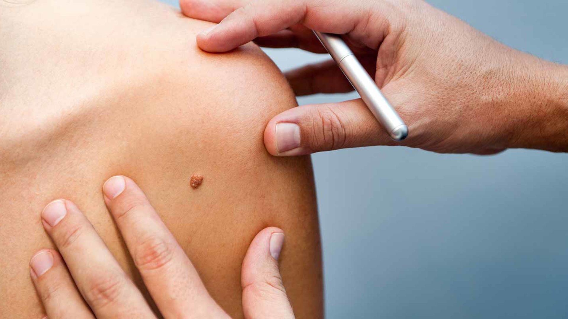 Dermatologische Hauterkrankungen behandeln im MVZ Hansaklinik in Dortmund