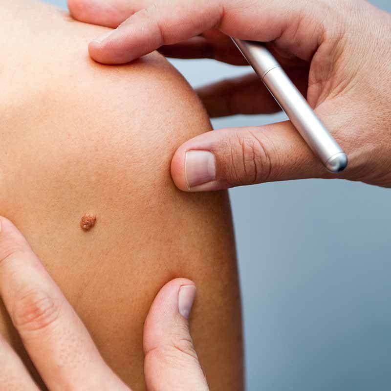 Dermatologische Hauterkrankungen behandeln im MVZ Hansaklinik in Dortmund