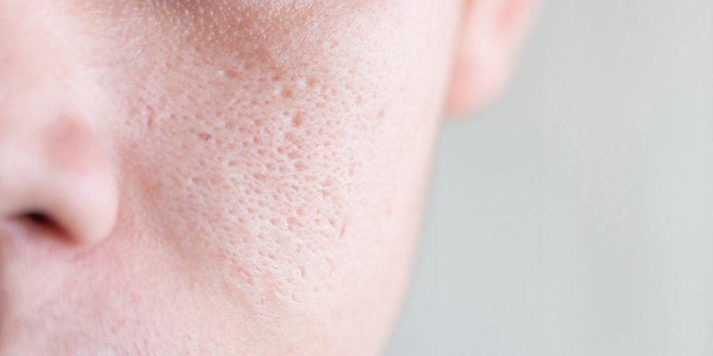 Die Behandlung von großporiger und unreiner Haut kann durch Laser erfolgen.