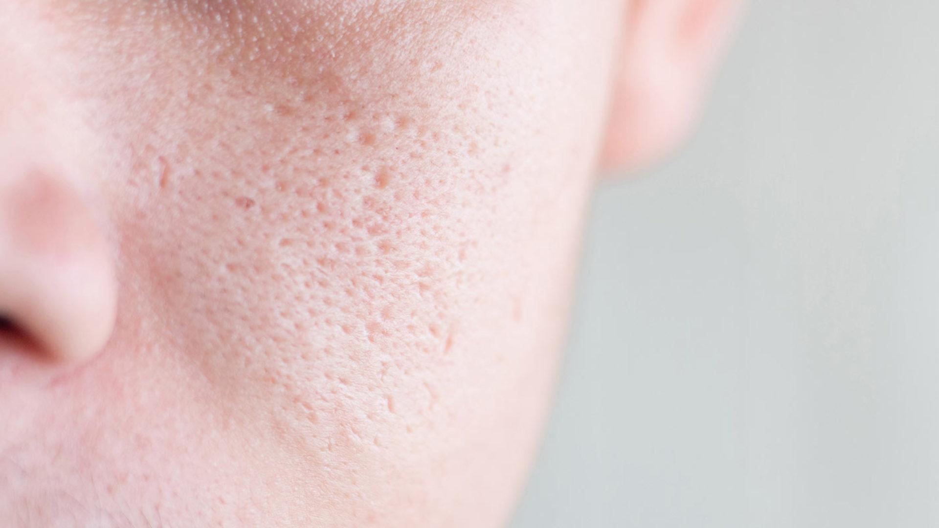 Die Behandlung von großporiger und unreiner Haut kann durch Laser erfolgen.