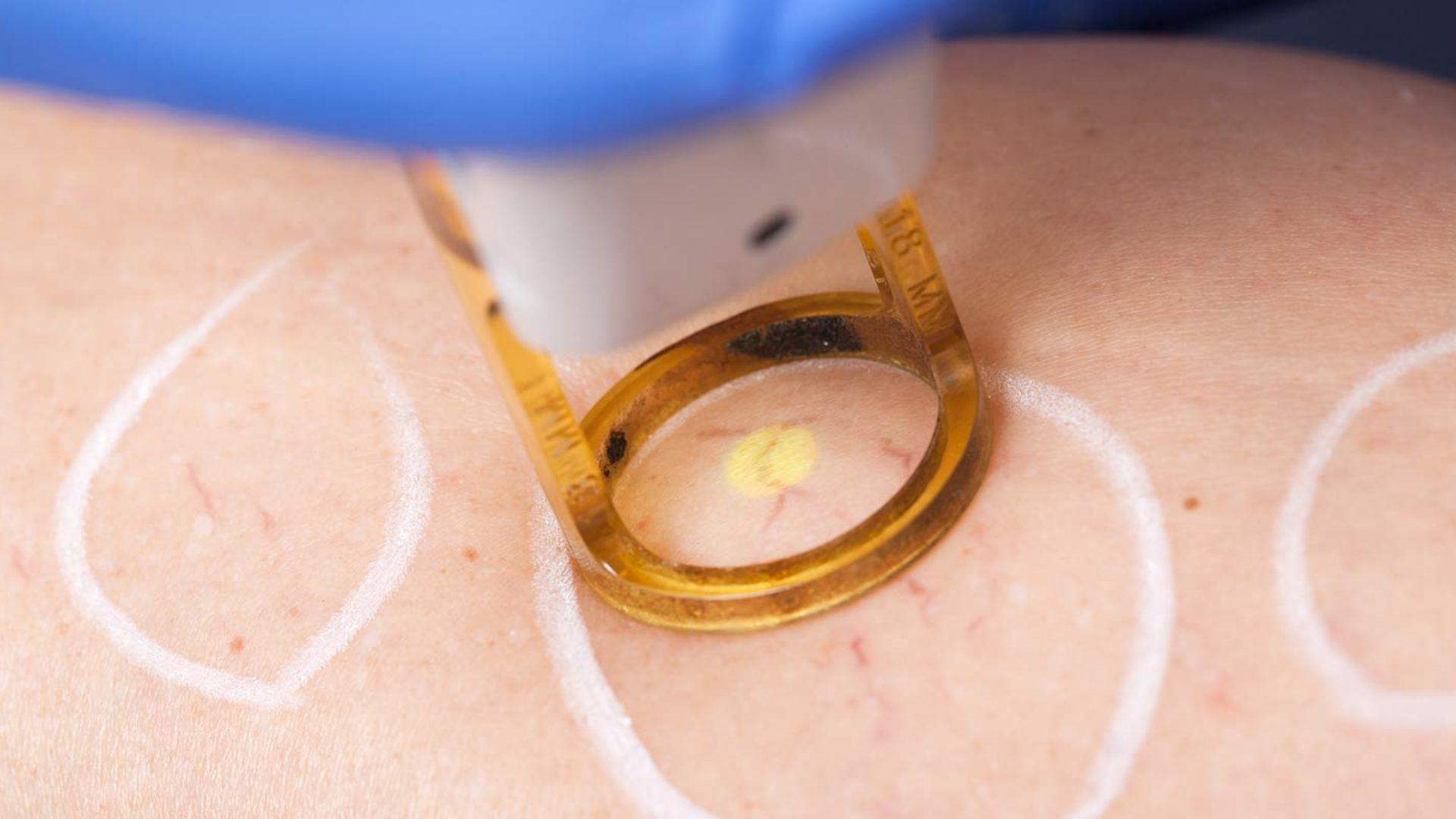 Lasertherapie im MVZ Hansaklinik