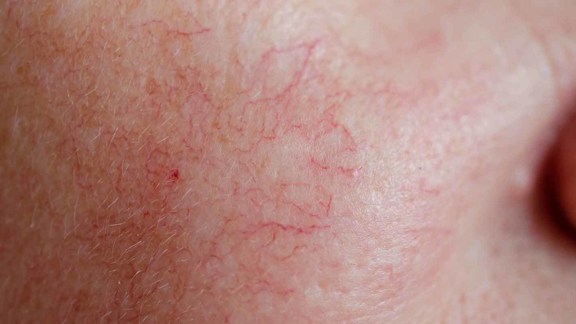 Rosacea im Gesicht kann durch verschiedene Behandlungsmethoden im MVZ Hansaklinik in Dortmund behandelt werden.