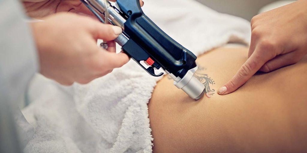 Unsere Ärzte sind erfahren in der Entfernung von Tattoos.