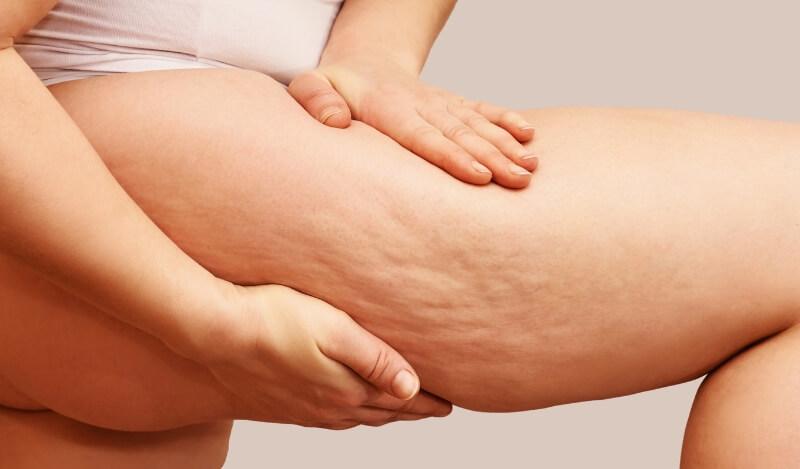 Frau zeigt Cellulite vor Behandlung im MVZ Hansaklinik in Dortmund