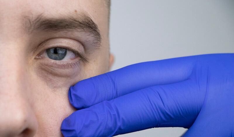 Mann will Augenringe unterspitzen lassen mit Hyaluronsäure