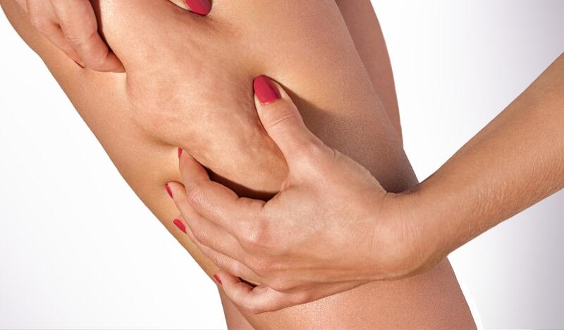 Frau betrachtet beine vor der Cellulite-Behandlung