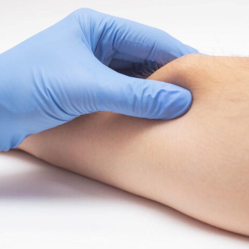 Arzt untersucht Lipom vor dem Entfernen